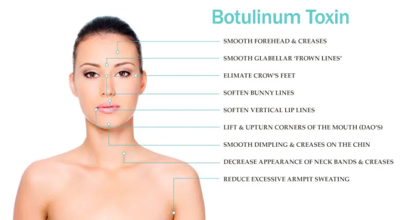 مكافحة التجاعيد لتخفيف الوزن Beutox Batulaxs Resty Dermal Filler Juvederms 0