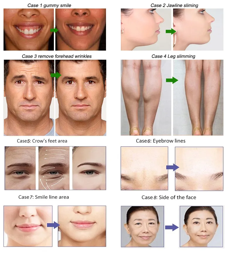 مكافحة التجاعيد لتخفيف الوزن Beutox Batulaxs Resty Dermal Filler Juvederms 1